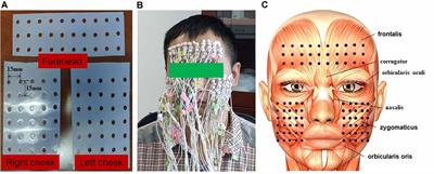 Comparison of <mark class="highlighted">Facial Muscle</mark> Activation Patterns Between Healthy and Bell’s Palsy Subjects Using High-Density Surface Electromyography